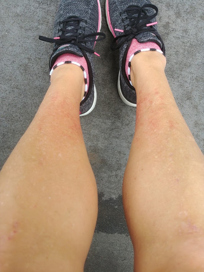 A women's legs showing an heat rash gotten while walking in extreme hot weather at Disney. 